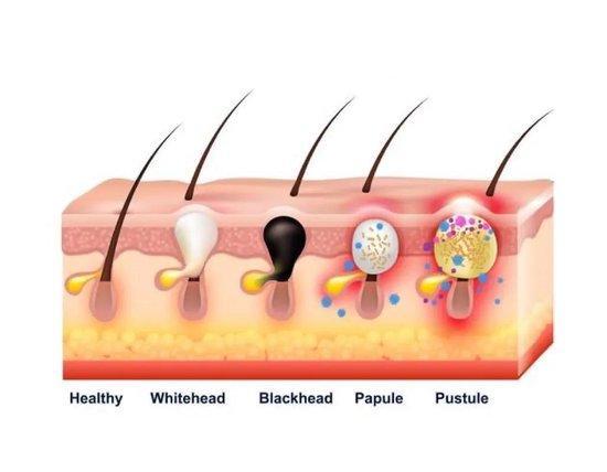 Hãy sử dụng axit yếu để "cấp cứu" cho làn da bị mụn bọc kín